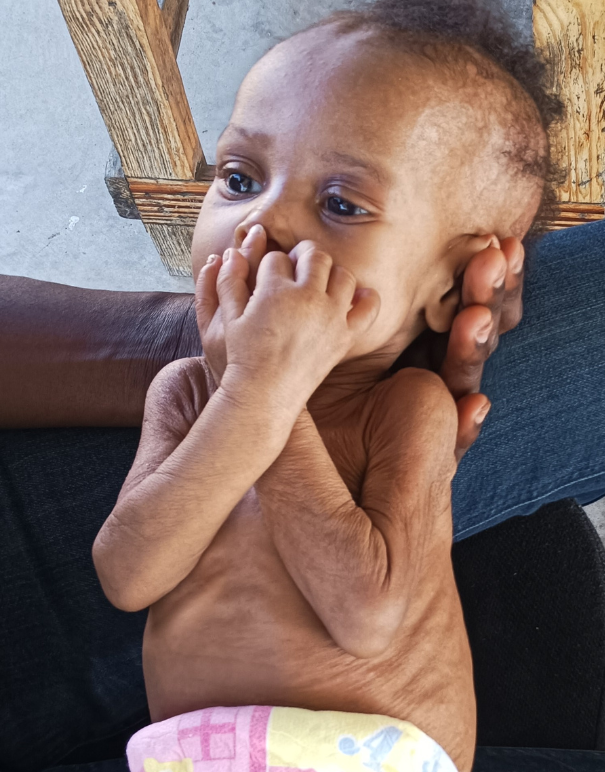 Dorlencia before treatment